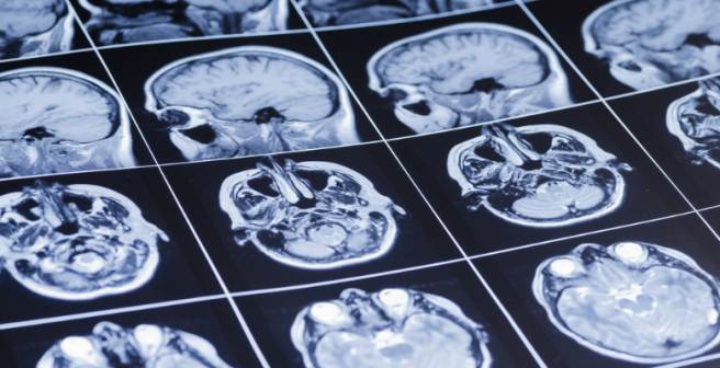 2014 Nobel Prize for Physiology/Medicine awarded to the discovery of 'place cells' in brain 2014 Nobel Prize for Physiology/Medicine awarded to the discovery of 'place cells' in brain
